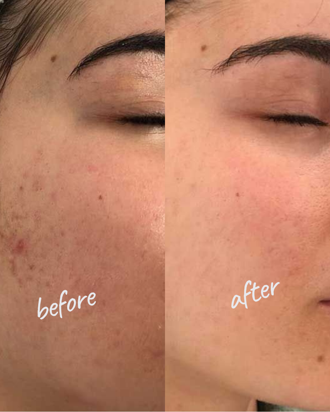 Microneedling with Vitamins or PRP NYC — Before and After